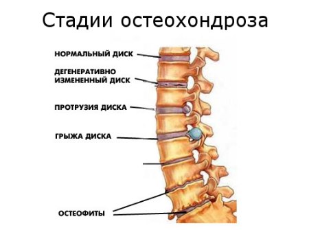 Кремы от остеохондроза: мази, бальзамы, гели и воск! Как делать массаж коленного сустава. (видео урок)